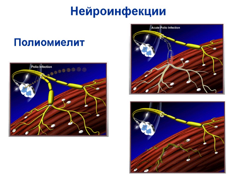 Нейроинфекции  Полиомиелит